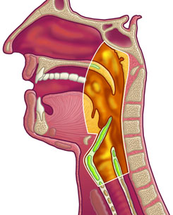 Head and neck cancer