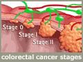 medical illustration - colorectal cancer stages
