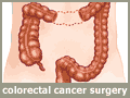 medical illustration - colorectal cancer surgery